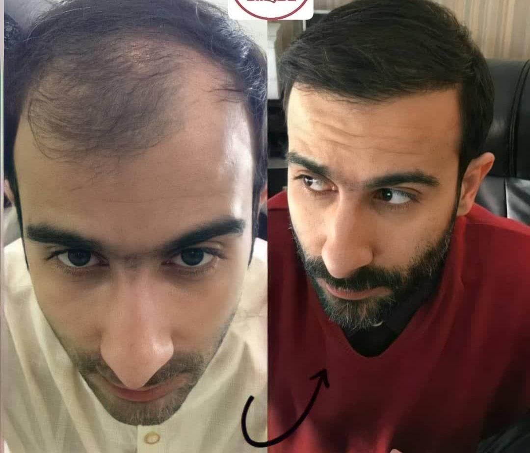 کاشت مو و ابرو کاملا تخصصی و حرفه ای|خدمات آرایشگری و زیبایی|تهران, نارمک جنوبی|دیوار