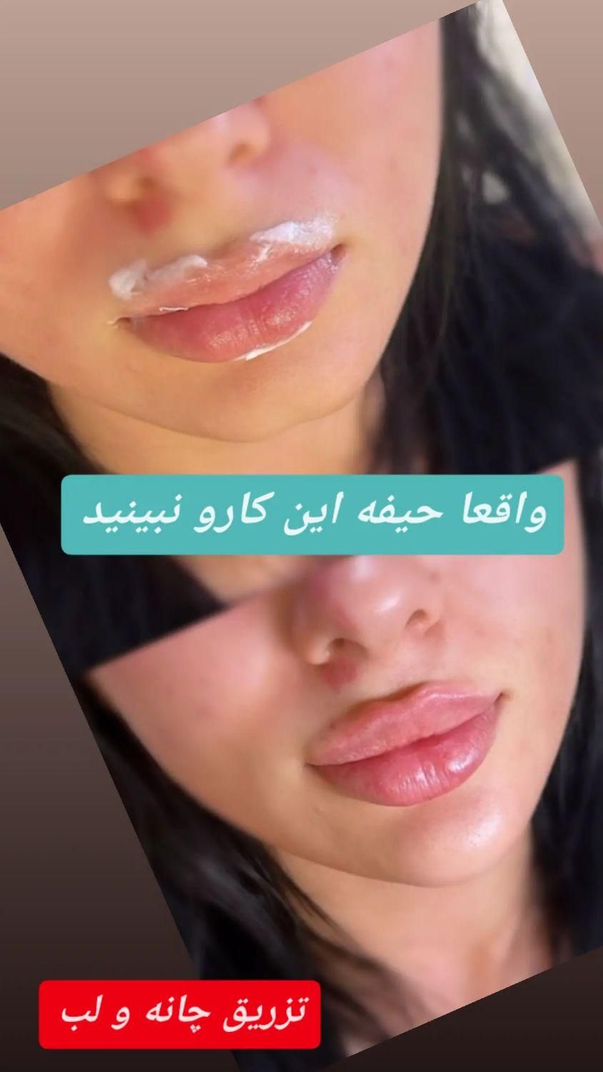 ژل لب،بوتاکس، جراحی پلک وبینی،مزوژل،لیفت صورت|خدمات آرایشگری و زیبایی|تهران, هروی|دیوار