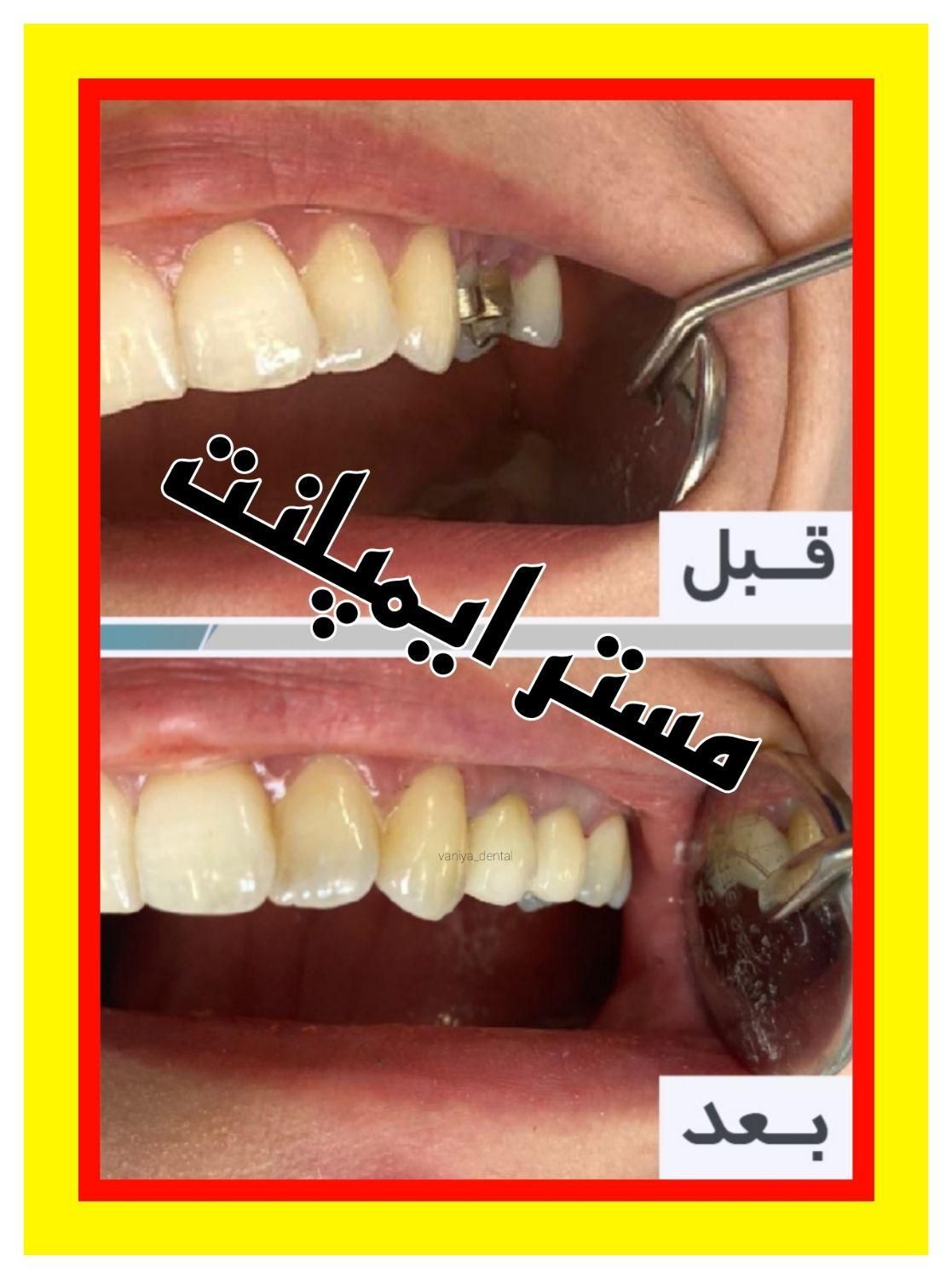 مستر ایمپلنت و ونیر کامپوزیت توسط پزشک|خدمات آرایشگری و زیبایی|تهران, تهران‌سر|دیوار