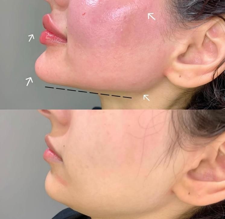 مدل ژل لب روسی نخ انزیم فیلر بوتاکس زاویه فیلربادی|خدمات آرایشگری و زیبایی|تهران, تهرانپارس غربی|دیوار