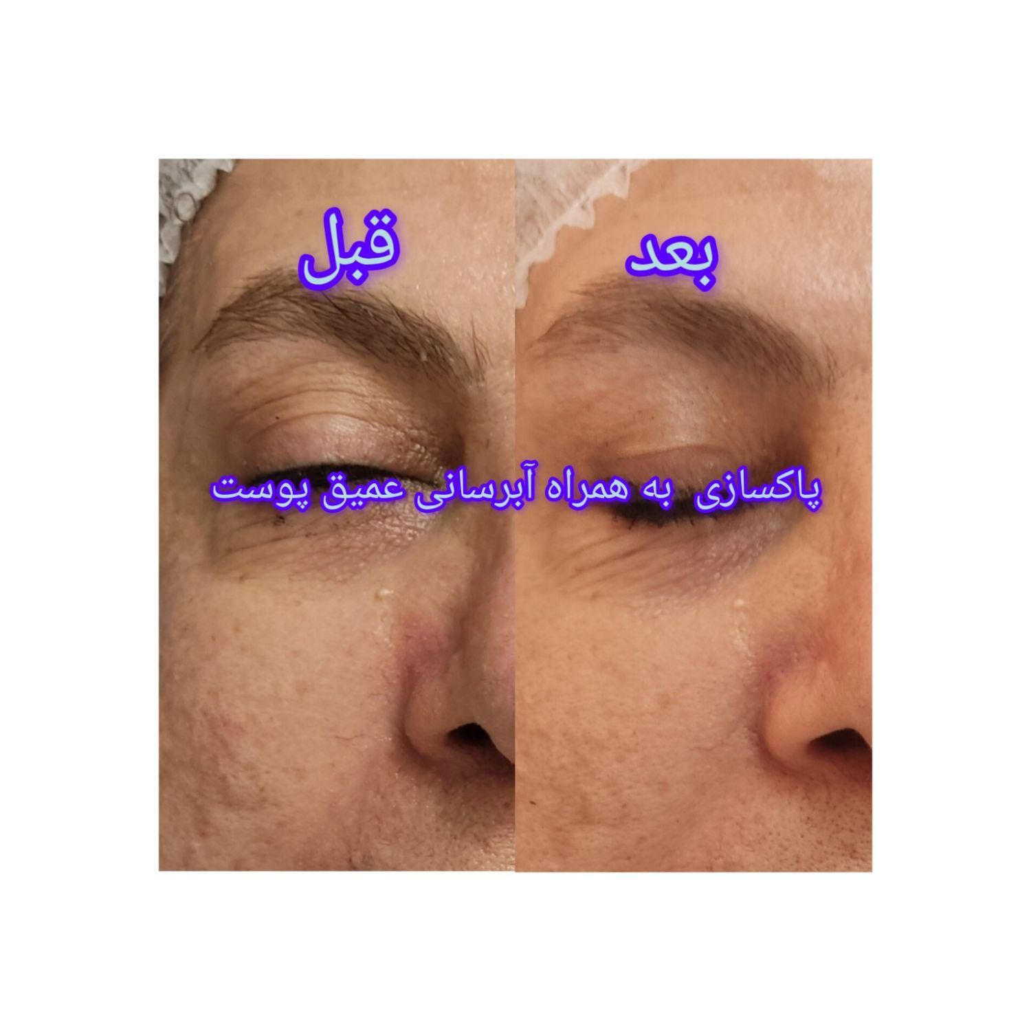 پاکسازی و فیشال تضمین کیفیت کار و مواد مصرفی|خدمات آرایشگری و زیبایی|تهران, فاطمی|دیوار