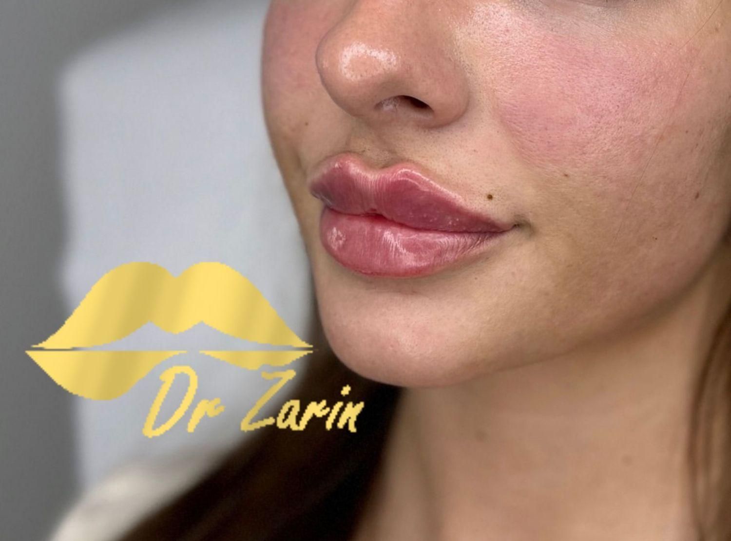 دکتر زرین لیپ ، فیلر لب روسی زاویه فک گونه چانه ژل|خدمات آرایشگری و زیبایی|تهران, پونک|دیوار
