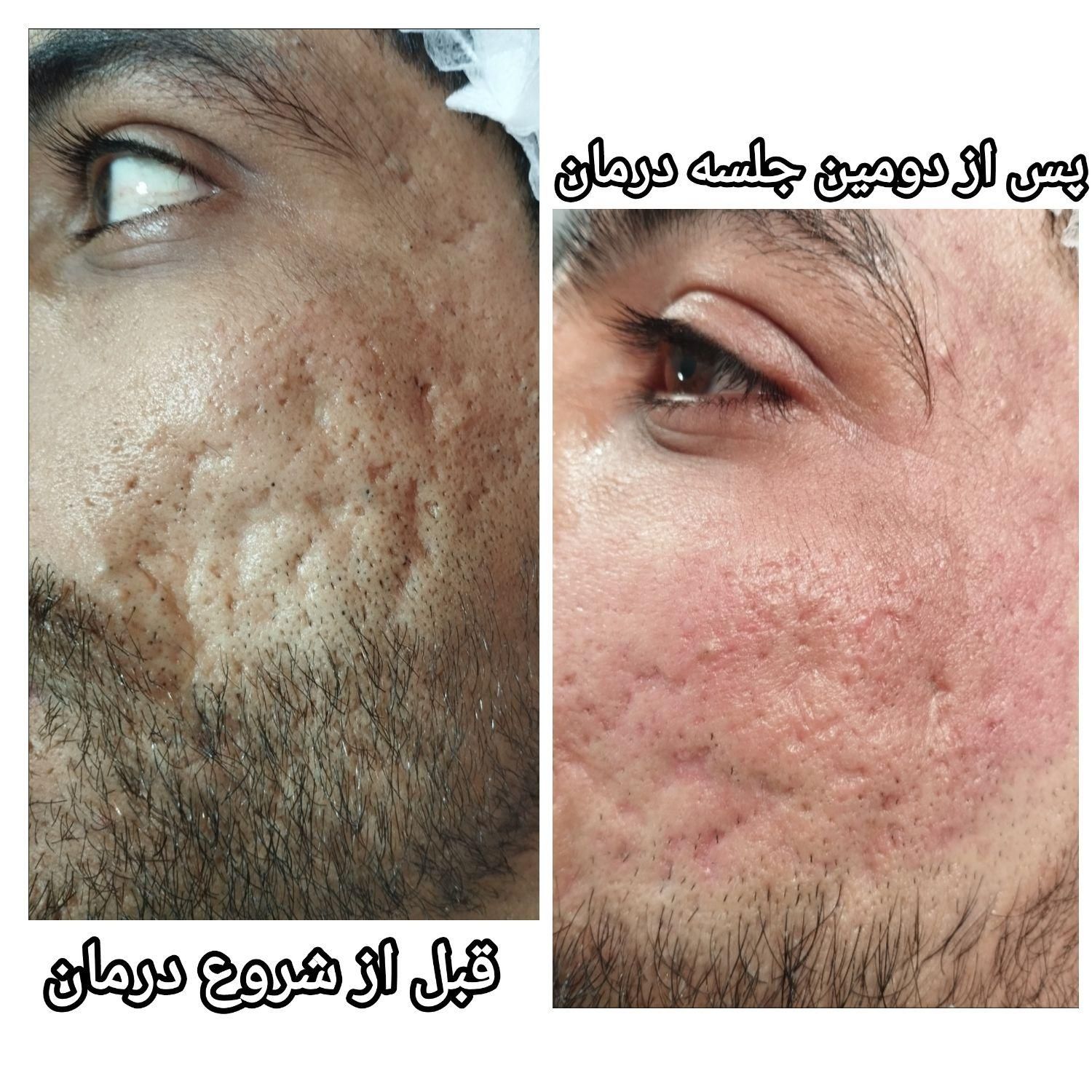 **درمان تخصصی و تضمینی اسکار آکنه**|خدمات آرایشگری و زیبایی|اصفهان, مولوی|دیوار