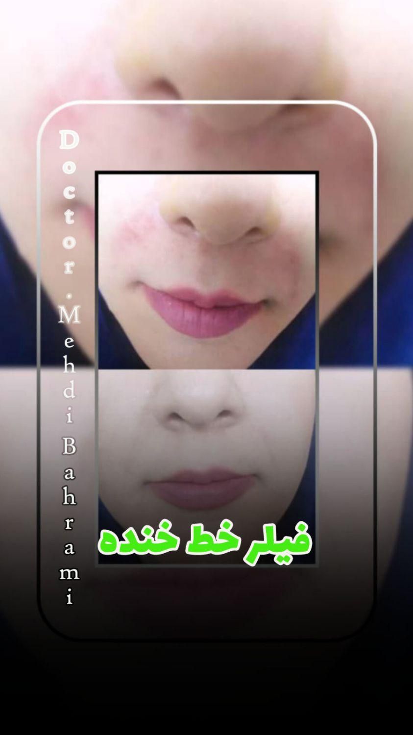 لیزرموی زایدتضمینی ژل وبوتاکس کلینیک دکتر بهرامی|خدمات آرایشگری و زیبایی|تهران, افسریه|دیوار