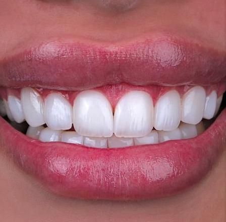 کامپوزیت دندان،لمینیت،روکش،عصب کشی|خدمات آرایشگری و زیبایی|تهران, سعادت‌آباد|دیوار