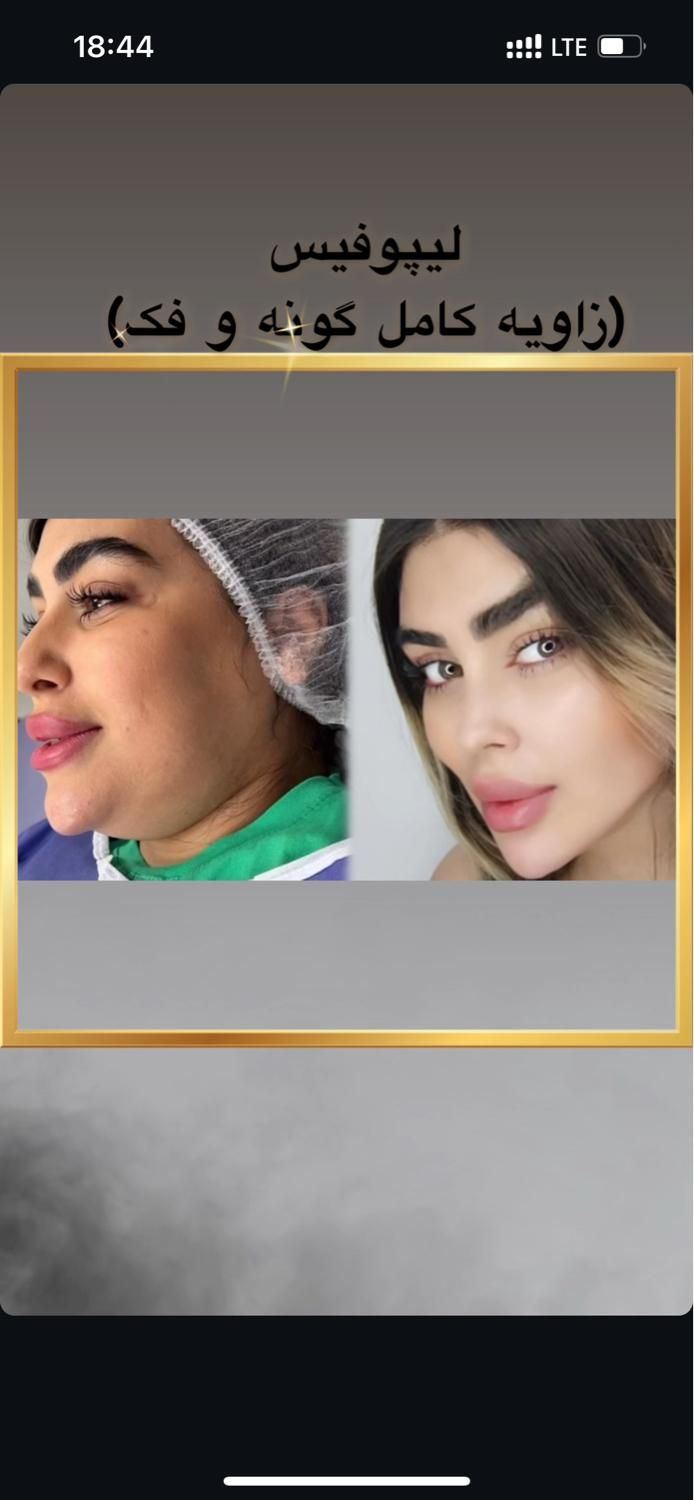 ساکشن غبغب نقد واقساط بوکال فت بلفارو کاشت ابرو|خدمات آرایشگری و زیبایی|تهران, پونک|دیوار