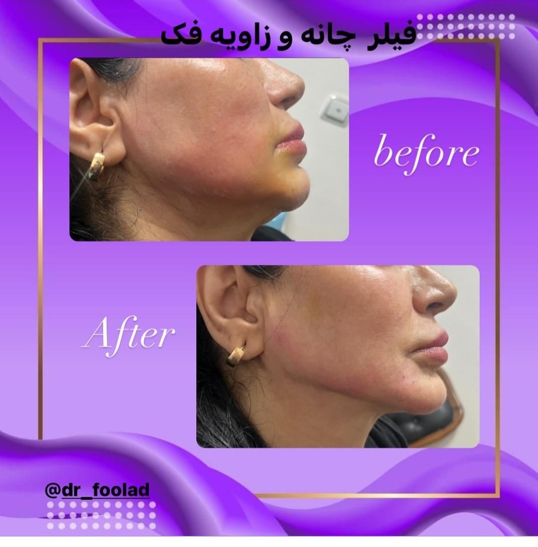 تخفیف بوتاکس،فیلر،هایفو،کربوکسی،مزوژل|خدمات آرایشگری و زیبایی|تهران, سازمان برنامه|دیوار