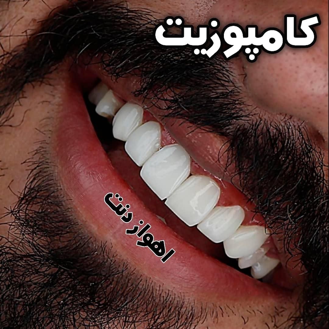 کامپوزیت دندان قسطی/ آموزش کامپوزیت قسطی در اهواز|خدمات آرایشگری و زیبایی|آبادان, |دیوار