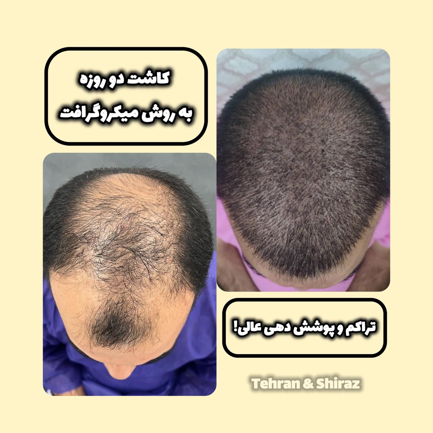 کاشت مو (شیرازی)|خدمات آرایشگری و زیبایی|تهران, سعادت‌آباد|دیوار