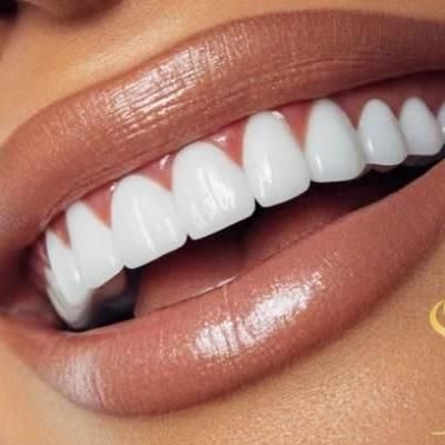 خدمات زیبایی دندان لمینت کامپوزیت لیانا|خدمات آرایشگری و زیبایی|تهران, نارمک|دیوار