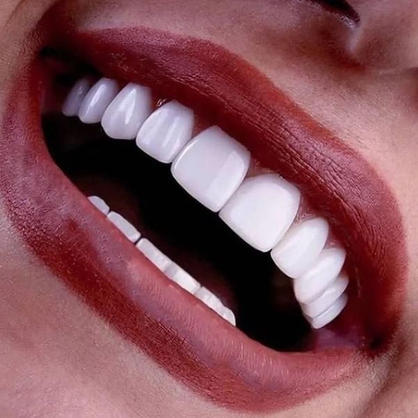 دندانپزشکی کامپوزیت/لمینت/روکش/ایمپلنت/عصبکشی|خدمات آرایشگری و زیبایی|تهران, سلسبیل|دیوار