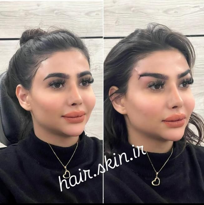 جشنواره50%تزریق ژل لب لیفت آنزیم 390بوتاکس لیزر|خدمات آرایشگری و زیبایی|تهران, شهرآرا|دیوار