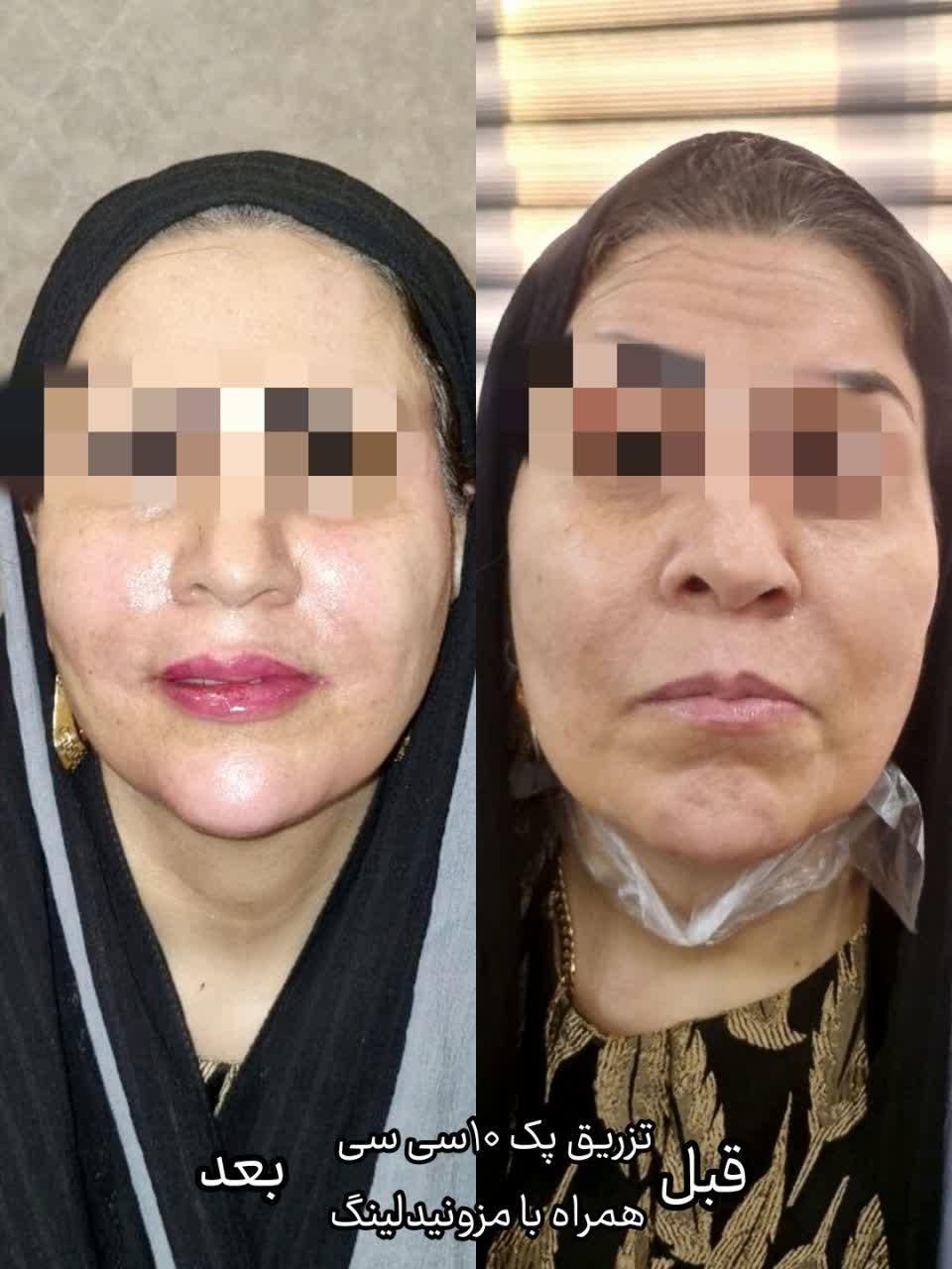 جشنواره مادلینگ فول فیس،ژل،بوتاکس،مزوتراپی، مزوژل|خدمات آرایشگری و زیبایی|قم, باجک (۱۹ دی)|دیوار