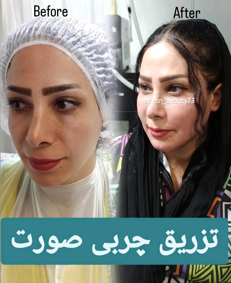 آموزش تخصصی بلفارو پلاستی و تزریق چربی|خدمات آموزشی|تهران, بلوار کشاورز|دیوار