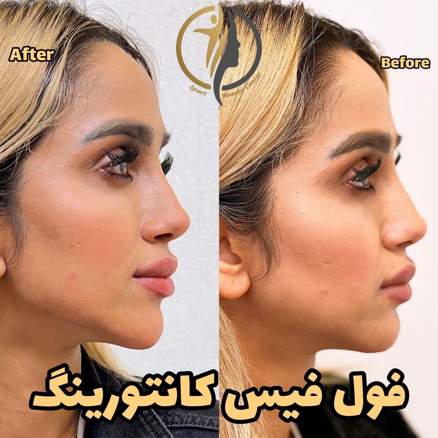 فیلر لب زاویه سازی صورت بوتاکس فیلر زیرچشم|خدمات آرایشگری و زیبایی|تهران, سعادت‌آباد|دیوار