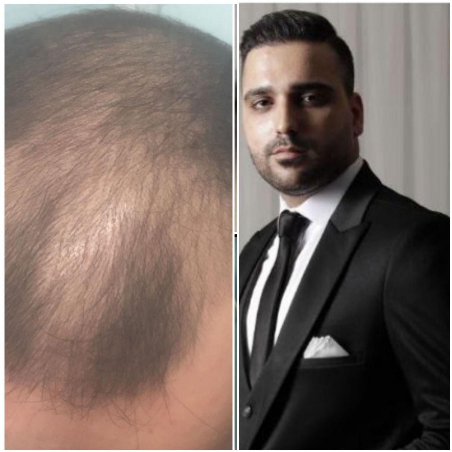 کاشت موی طبیعی سبک شیرازی|خدمات آرایشگری و زیبایی|تهران, زعفرانیه|دیوار