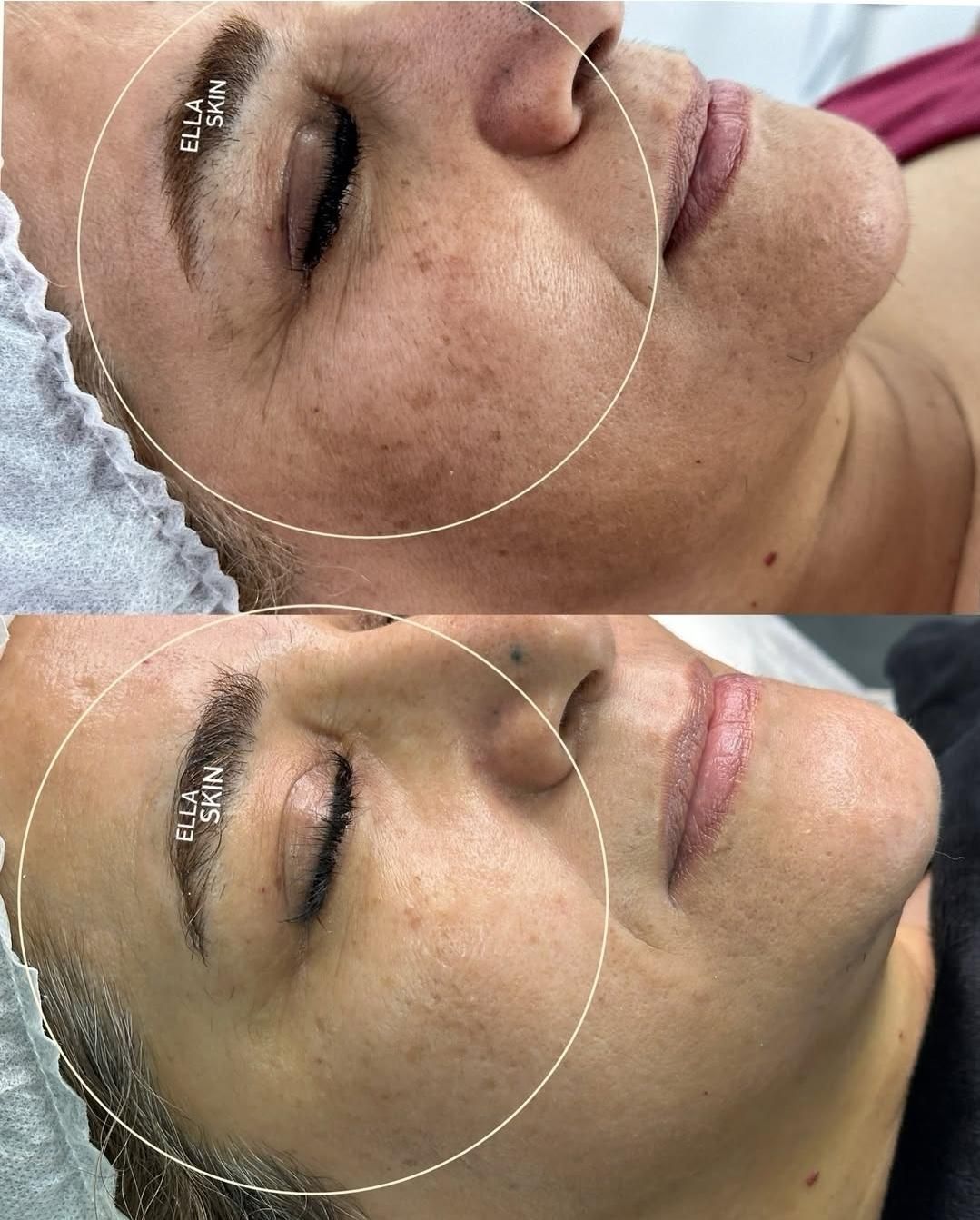 فیشیال پاکسازی و درمان تضمینی پوست|خدمات آرایشگری و زیبایی|کرمانشاه, |دیوار