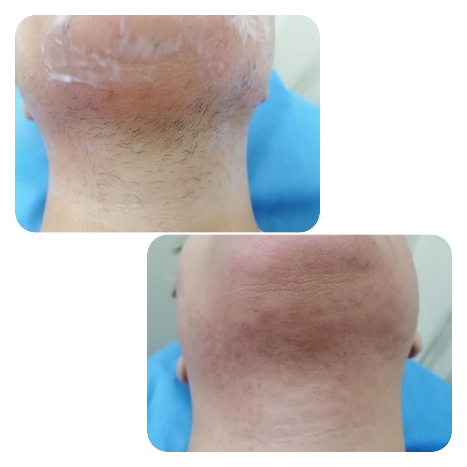 الکترولیز بانوان (رفع دائمی موهای زائد صورت و بدن)|خدمات آرایشگری و زیبایی|شیراز, گویم|دیوار