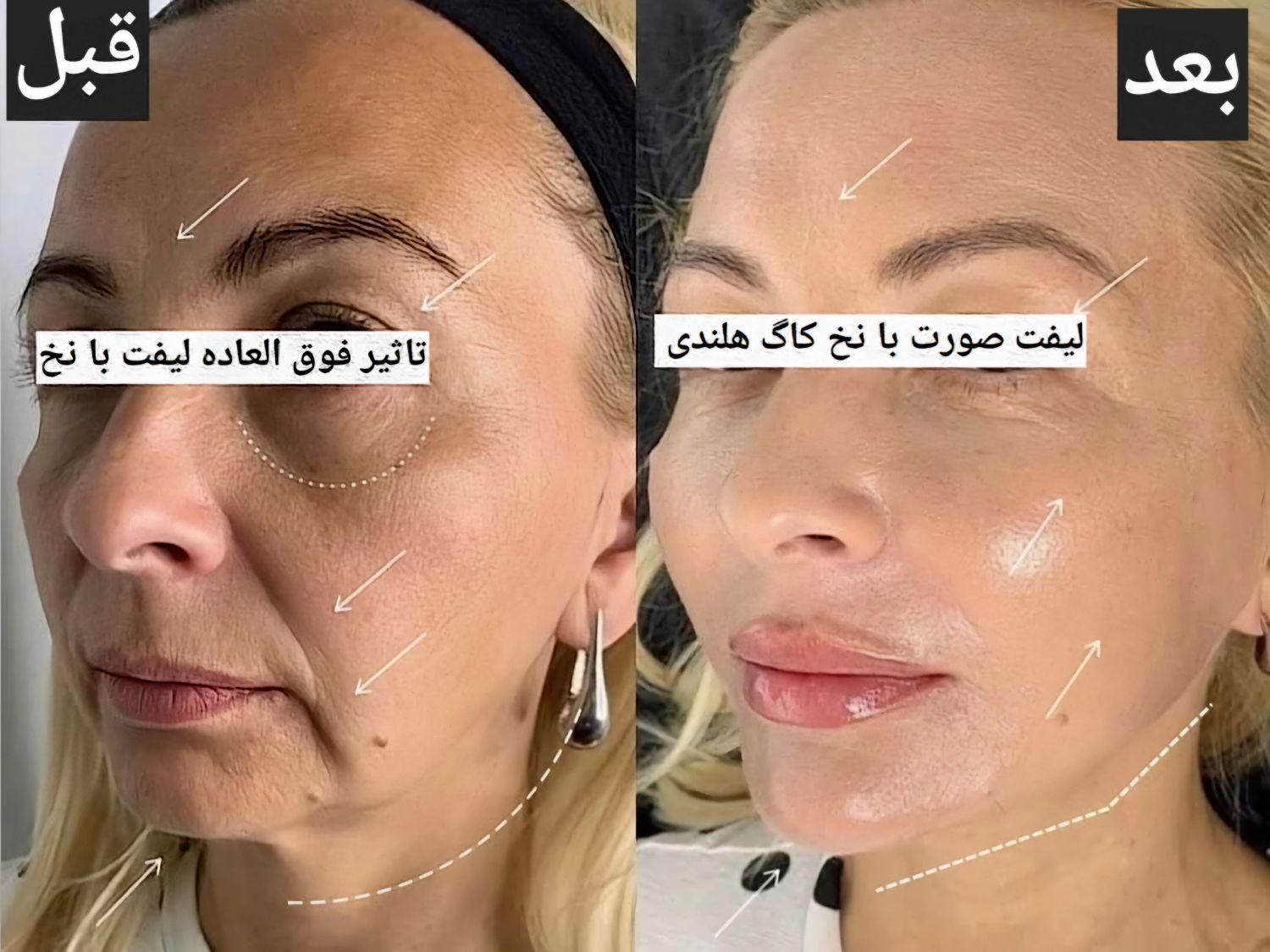 جشنواره مرکز تزریق چربی صورت ،ژل ،بوتاکس.prp|خدمات آرایشگری و زیبایی|کرج, اصفهانی‌ها|دیوار
