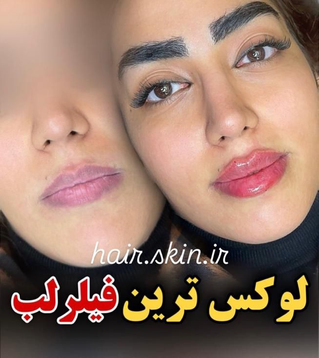 جشنواره50%تزریق ژل لب لیفت آنزیم 390بوتاکس لیزر|خدمات آرایشگری و زیبایی|تهران, شهرآرا|دیوار