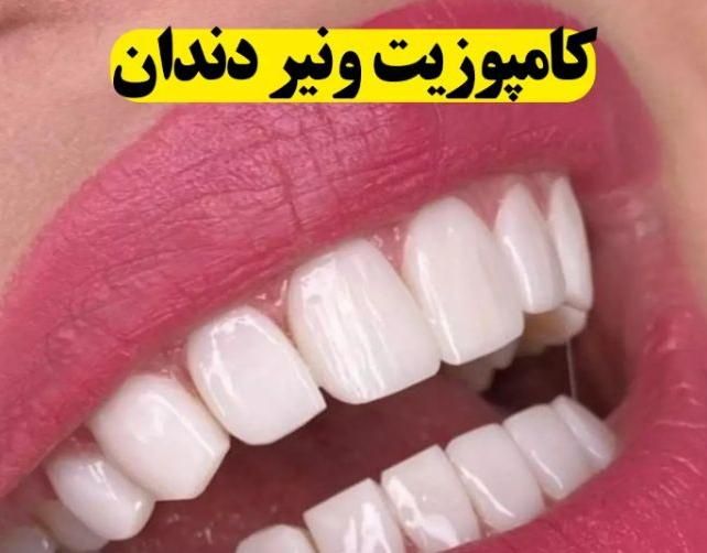 کامپوزیت دندان number 1 جشنواره|خدمات آرایشگری و زیبایی|تهران, هفت حوض|دیوار