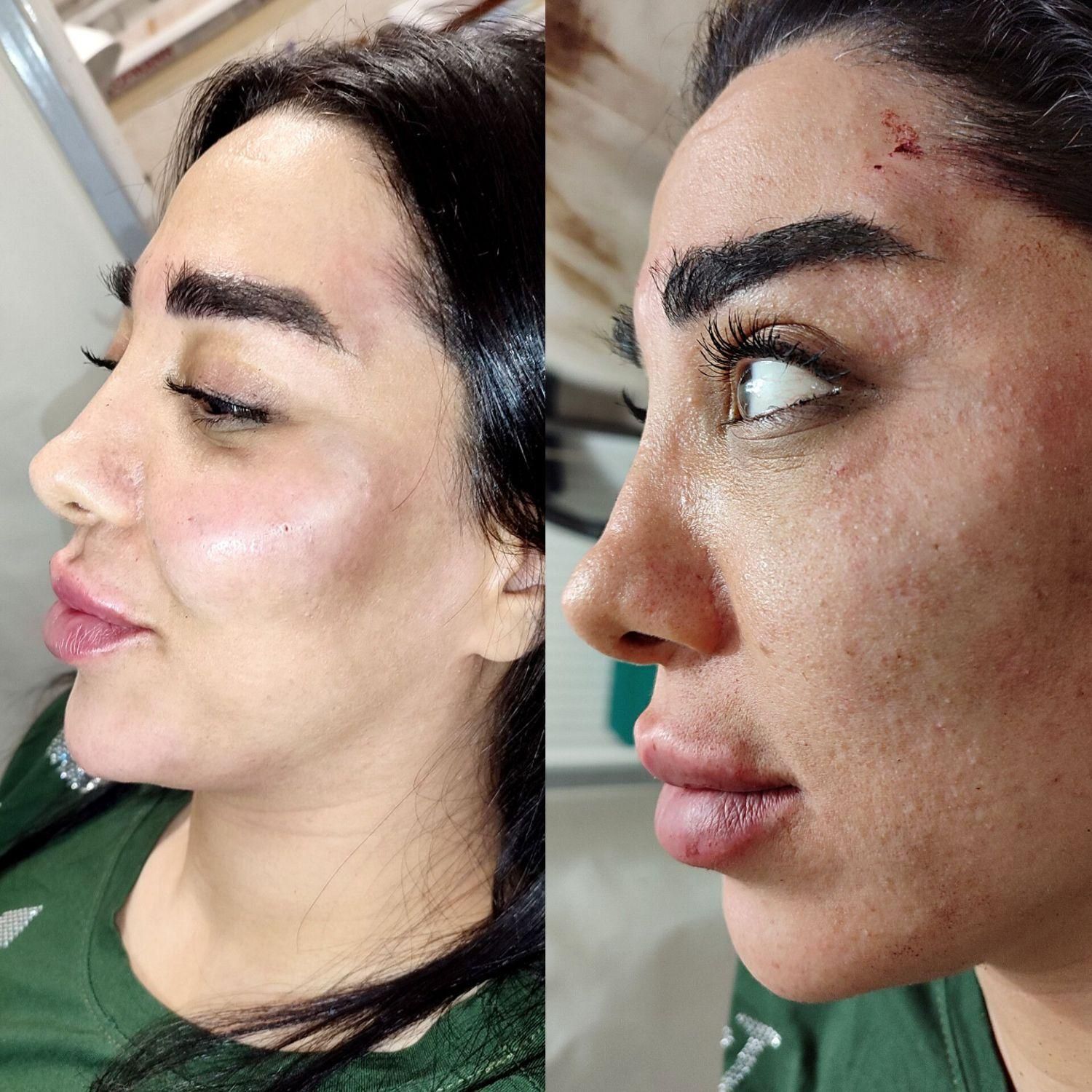 فیلر ، ژل و بوتاکس|خدمات آرایشگری و زیبایی|رباط‌کریم, |دیوار
