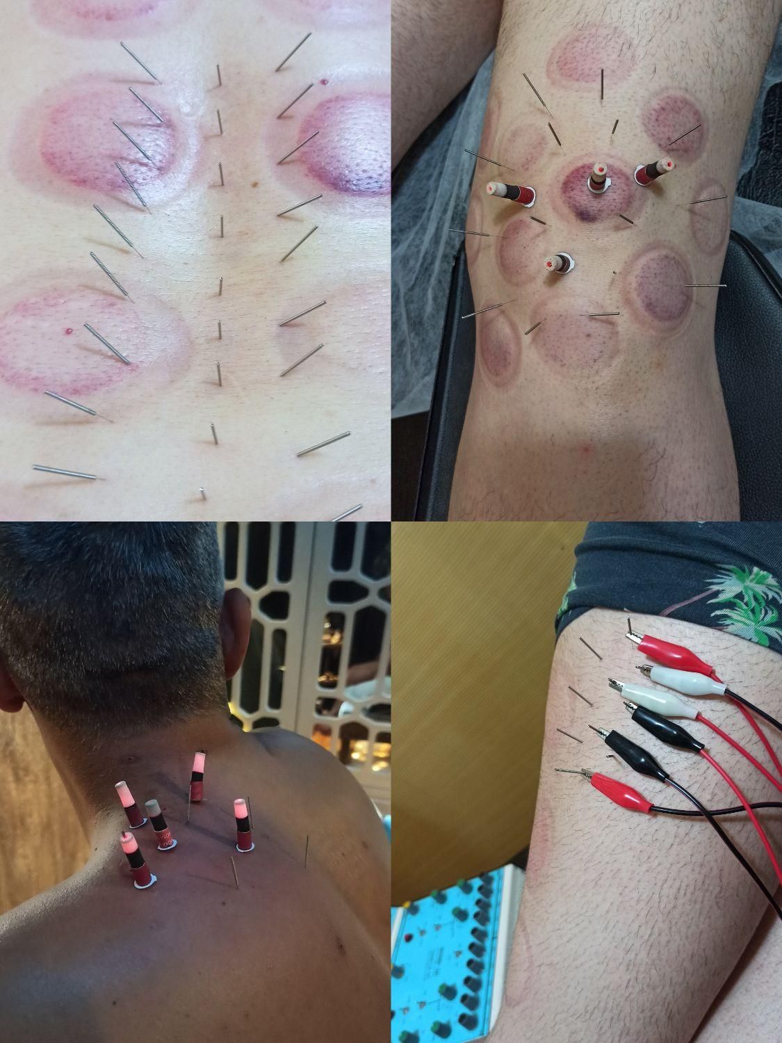دیسک کمر سیاتیک فیزیوتراپی بادکش زالو درمانی حجامت|خدمات آرایشگری و زیبایی|تهران, پلیس|دیوار