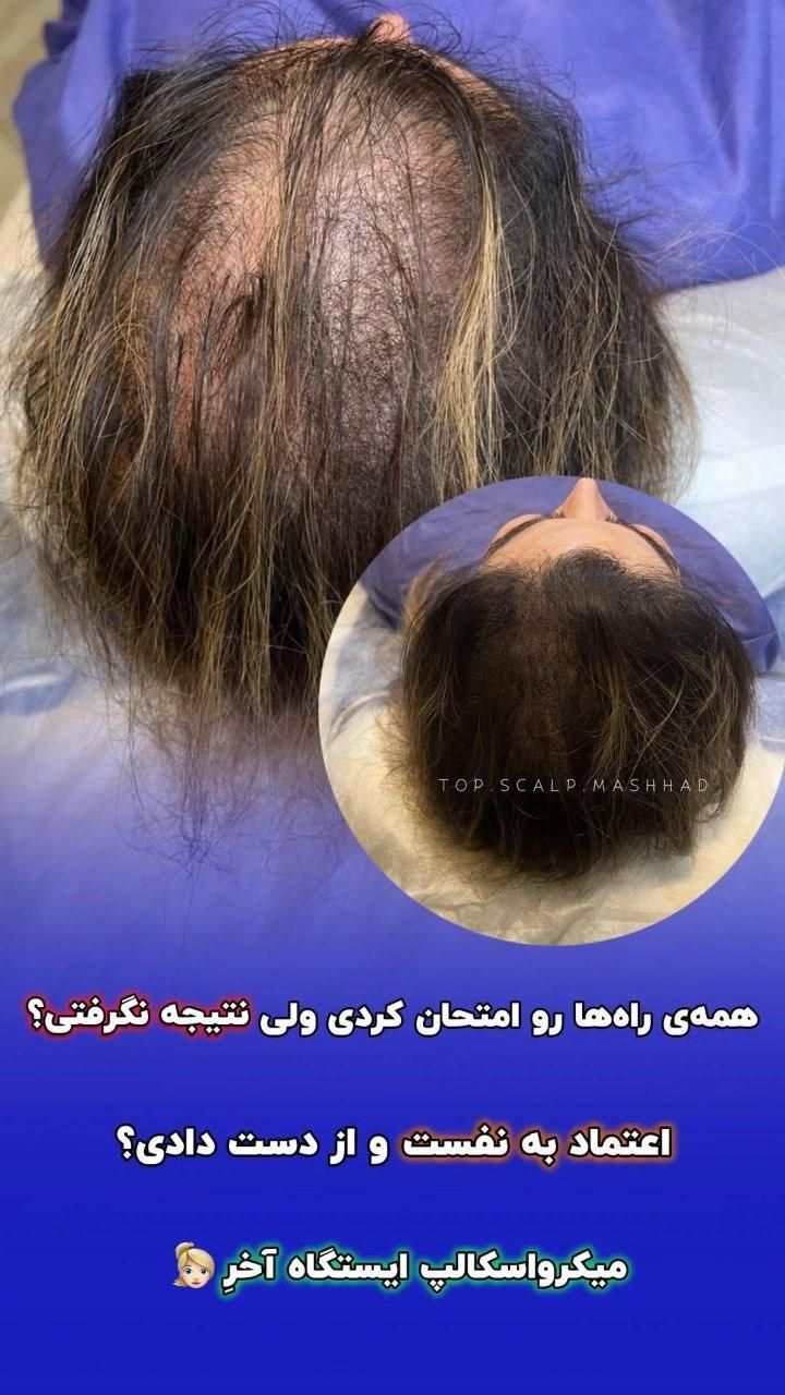 تکنیک جدید جایگزین کاشتمو میکرو اسکالپ|خدمات آرایشگری و زیبایی|تهران, تهرانپارس غربی|دیوار