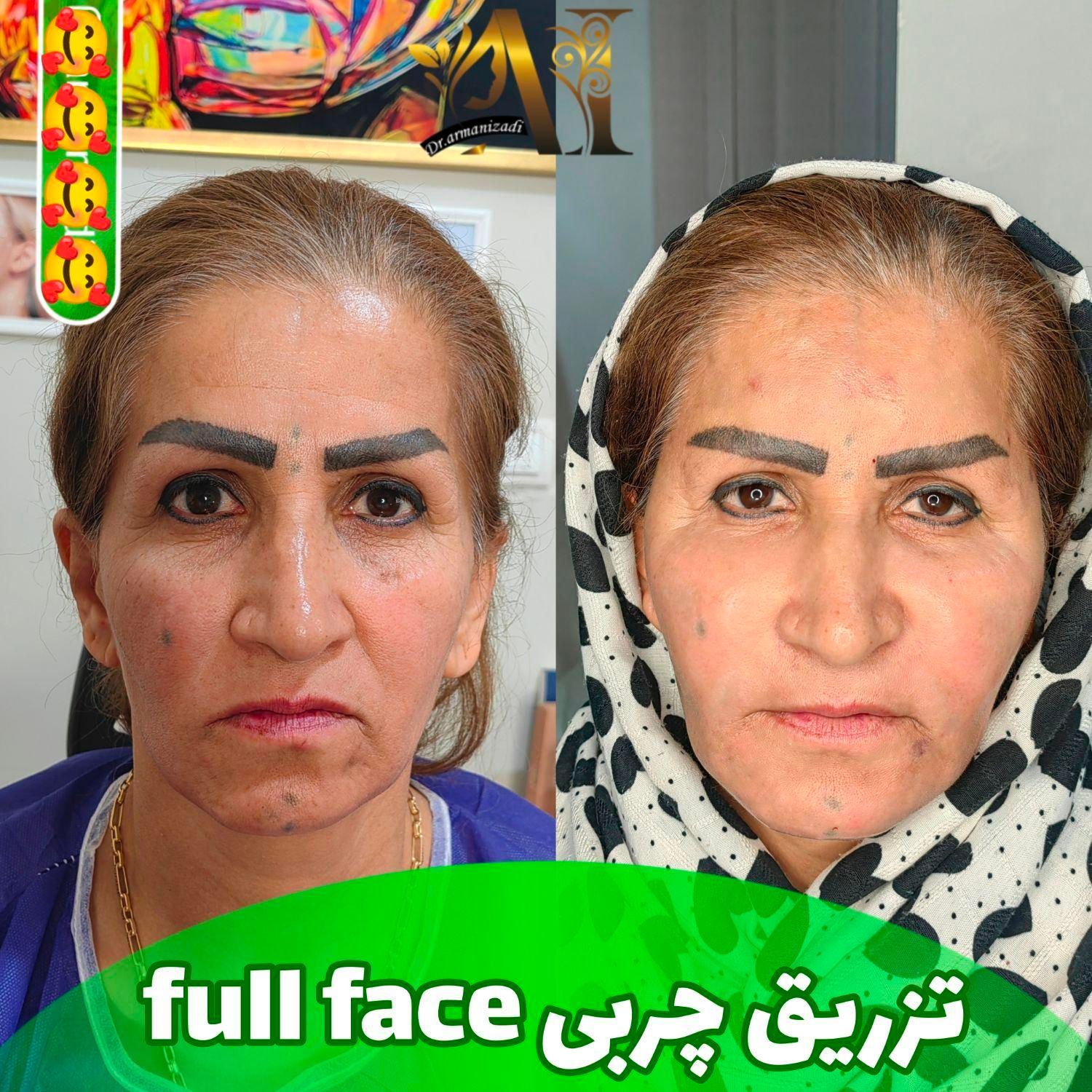 فیلر بادی، جراحی سرپایی زیبایی حجم دهی صورت بدن|خدمات آرایشگری و زیبایی|مرودشت, رودبال|دیوار