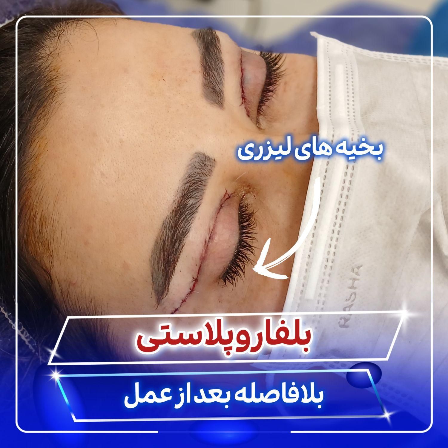 بلفاروپلاستی توسط جراح و متخصص چشم|خدمات آرایشگری و زیبایی|تهران, صادقیه|دیوار