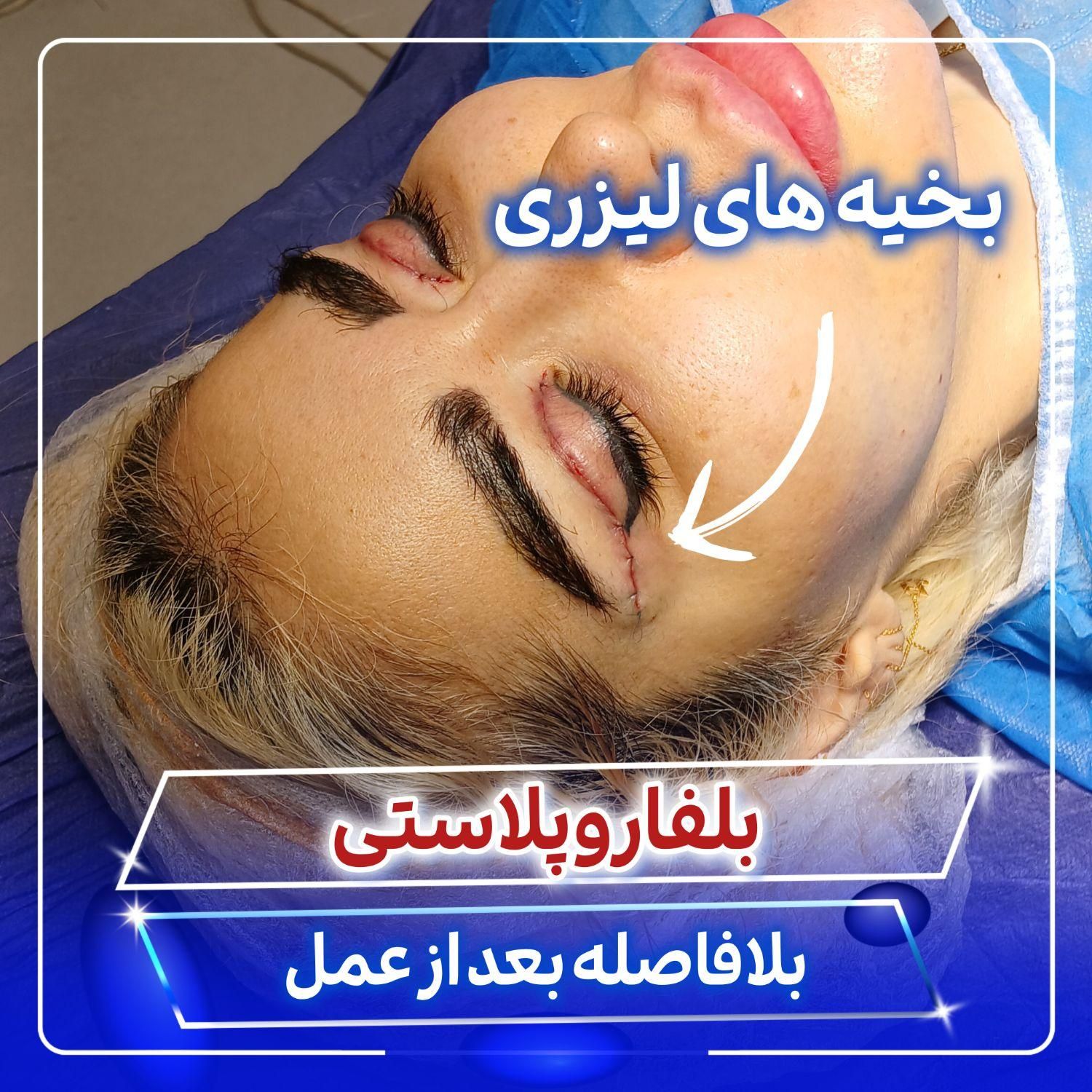 بلفاروپلاستی توسط جراح و متخصص چشم|خدمات آرایشگری و زیبایی|تهران, صادقیه|دیوار