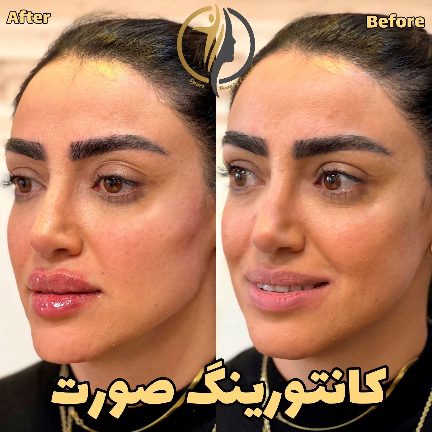 فیلر لب زاویه سازی صورت بوتاکس فیلر زیرچشم|خدمات آرایشگری و زیبایی|تهران, سعادت‌آباد|دیوار