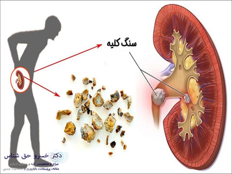 دفع سنگ کلیه تضمینی|خدمات آرایشگری و زیبایی|ایلام, |دیوار