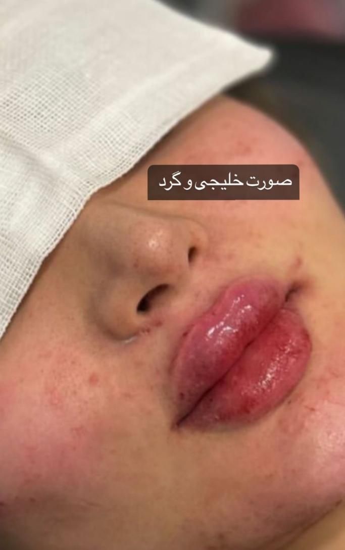 ژل لب گونه چونه زاویه سازی بوتاکس خط خنده|خدمات آرایشگری و زیبایی|قم, زنبیل‌آباد (شهید صدوقی)|دیوار