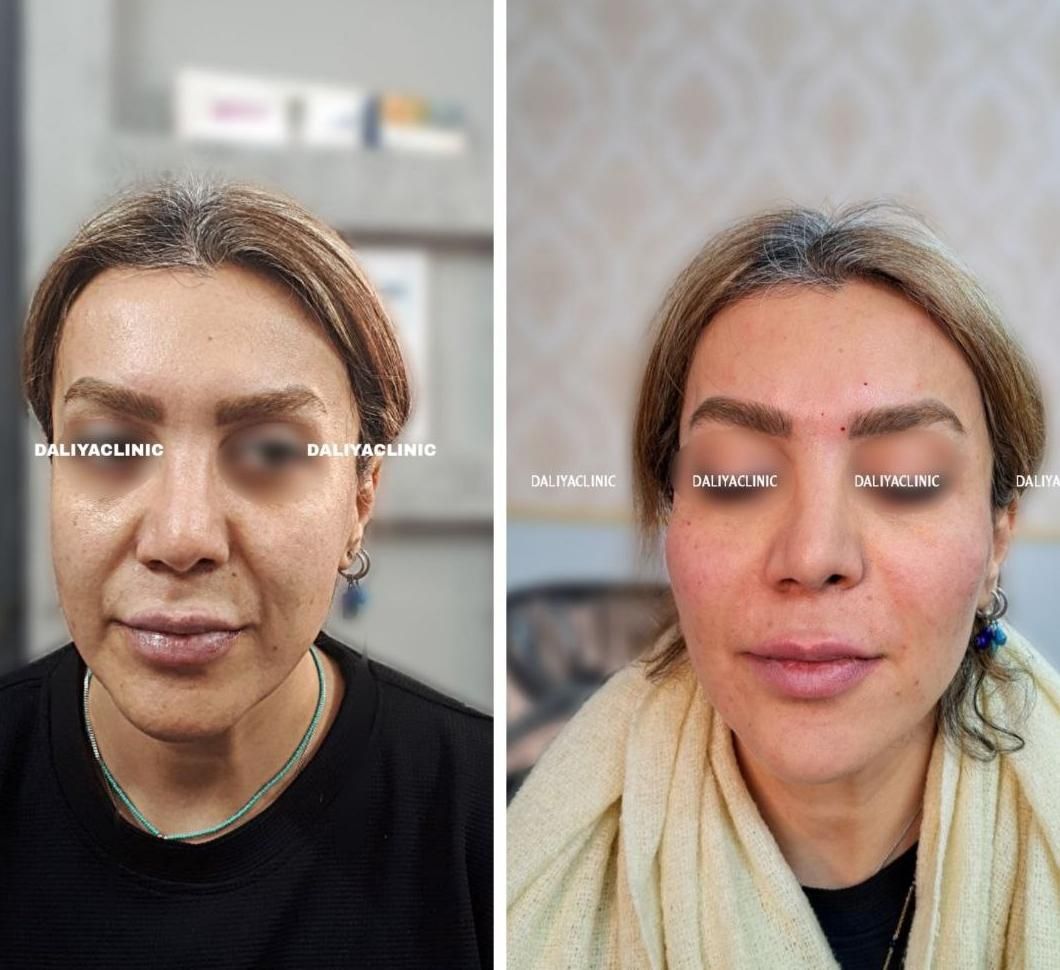 تزریق ژل (فیلر) وبوتاکس و لیفت بانخ ومادلینگ|خدمات آرایشگری و زیبایی|تهران, هفت حوض|دیوار
