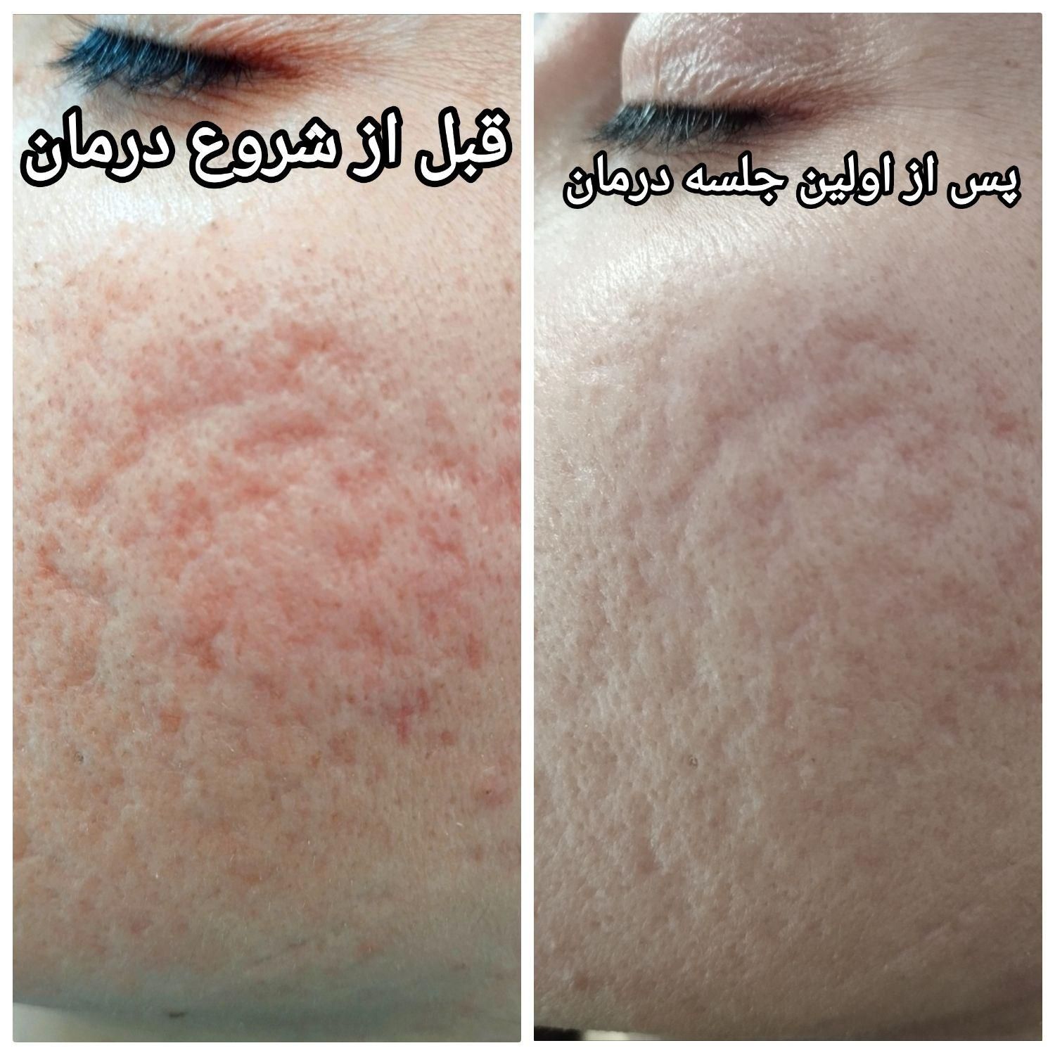 **درمان تخصصی و تضمینی اسکار آکنه**|خدمات آرایشگری و زیبایی|اصفهان, مولوی|دیوار