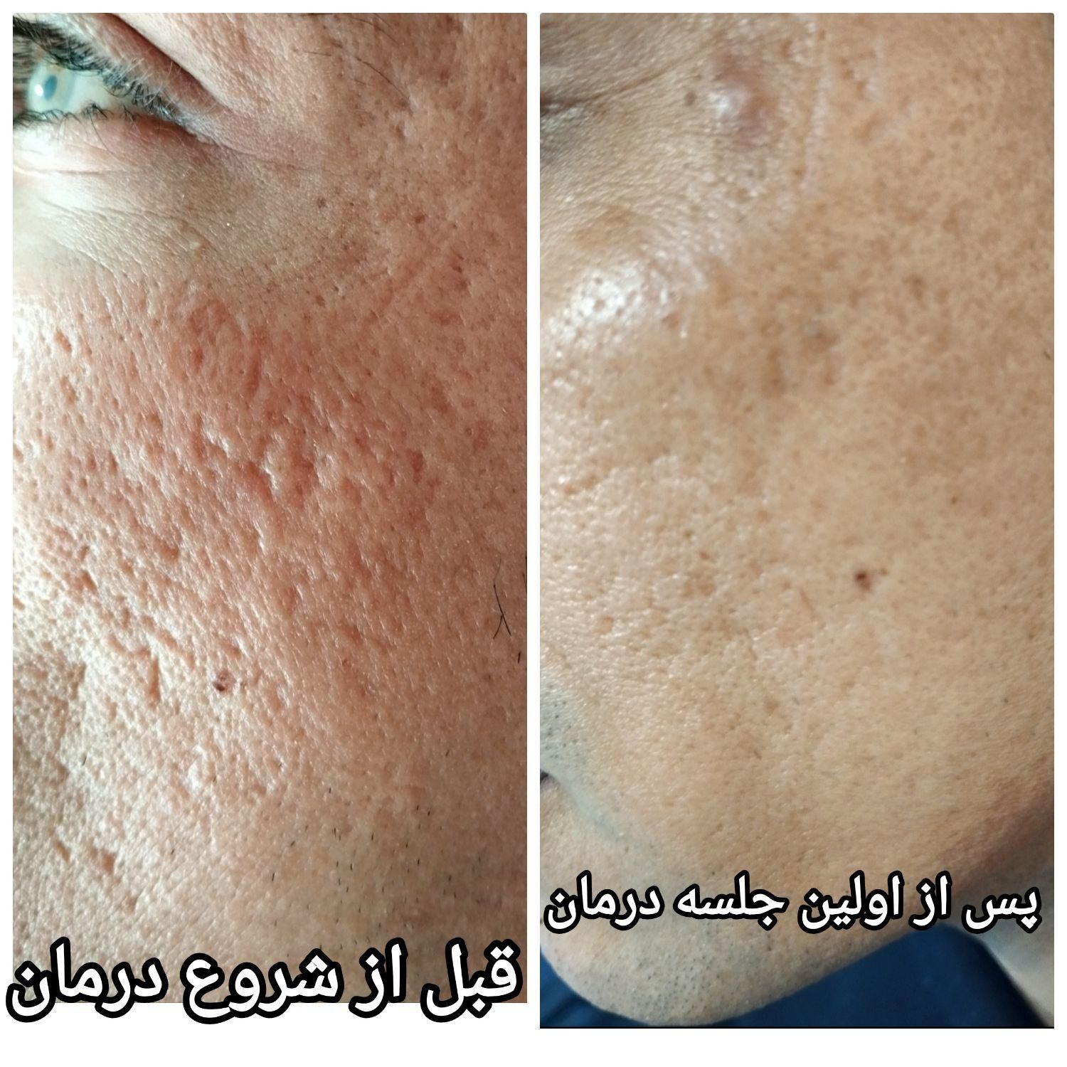 **درمان تخصصی و تضمینی اسکار آکنه**|خدمات آرایشگری و زیبایی|اصفهان, مولوی|دیوار