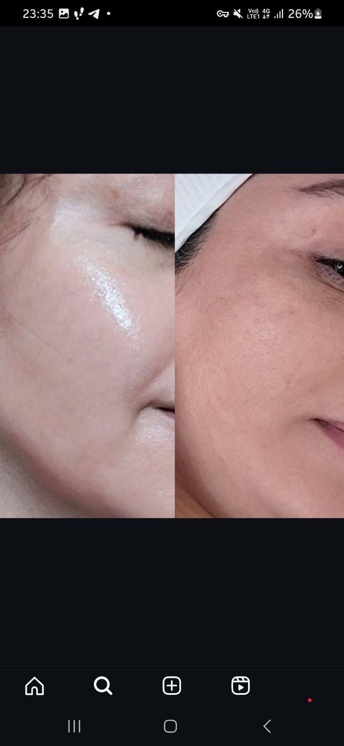 فیشیال پاکسازی و درمان تضمینی پوست|خدمات آرایشگری و زیبایی|کرمانشاه, |دیوار