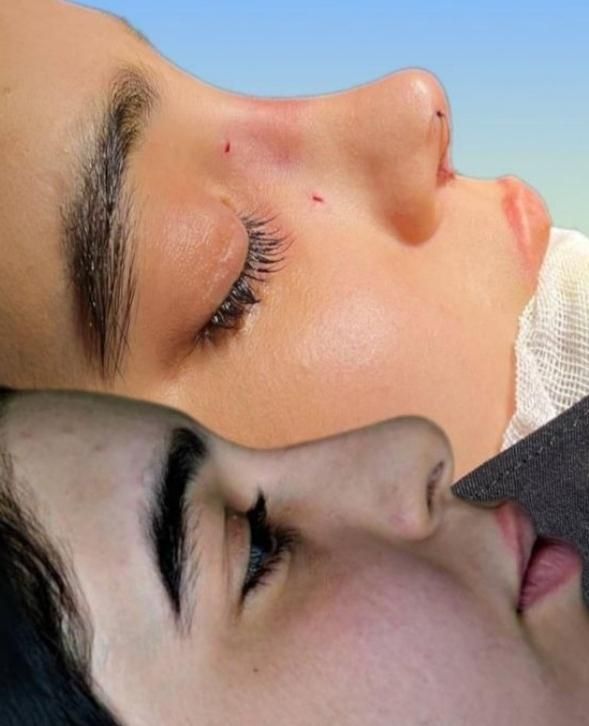 عمل بینی/سانترال لب/بلفارو پلاستی|خدمات آرایشگری و زیبایی|مشهد, احمدآباد|دیوار