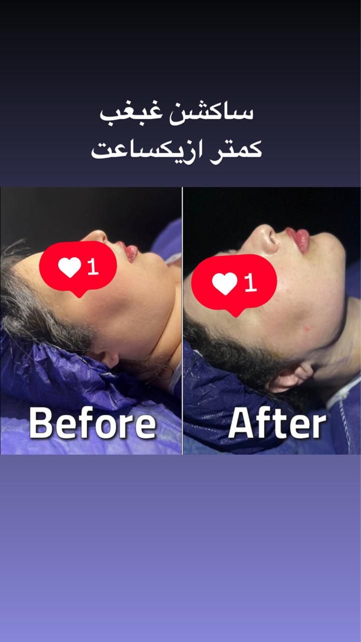 ساکشن غبغب نقد واقساط بوکال فت بلفارو کاشت ابرو|خدمات آرایشگری و زیبایی|تهران, پونک|دیوار