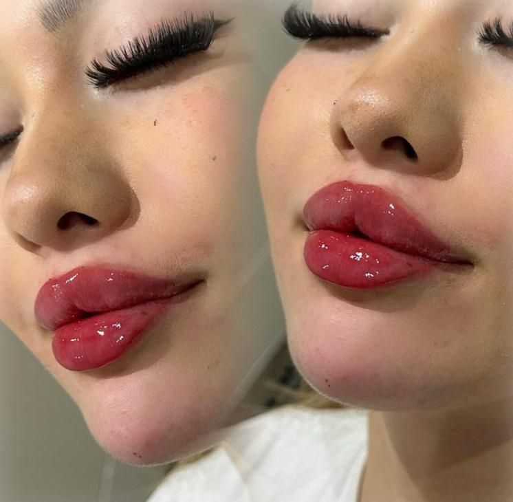 مدل ژل لب روسی نخ انزیم فیلر بوتاکس زاویه فیلربادی|خدمات آرایشگری و زیبایی|تهران, تهرانپارس غربی|دیوار
