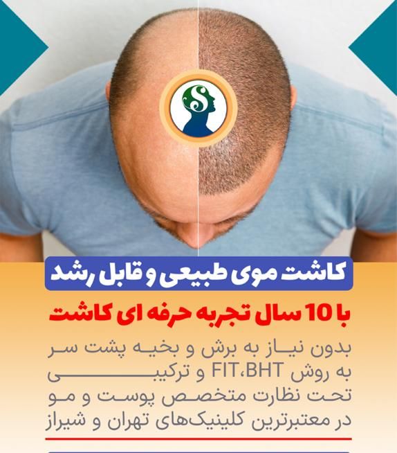 کاشت موی شیرازی|خدمات آرایشگری و زیبایی|تهران, سعادت‌آباد|دیوار