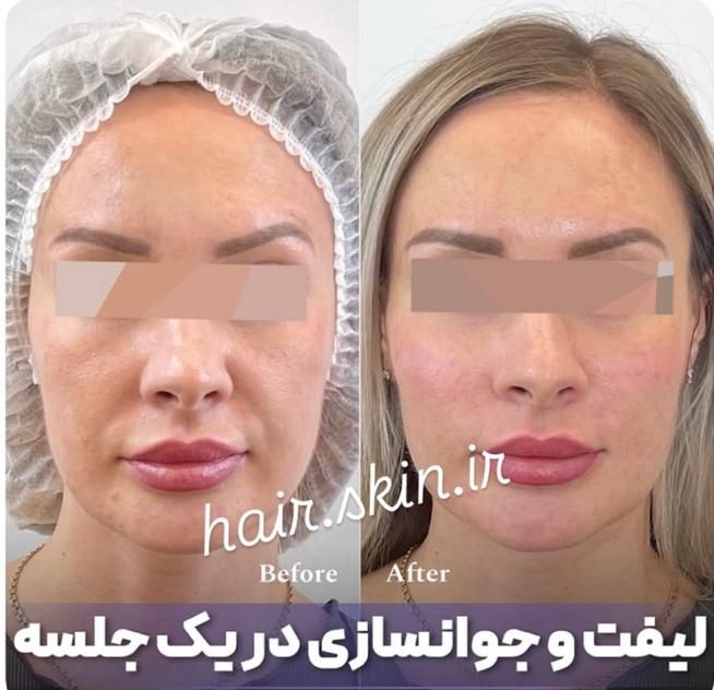 جشنواره50%تزریق ژل لب لیفت آنزیم 390بوتاکس لیزر|خدمات آرایشگری و زیبایی|تهران, شهرآرا|دیوار