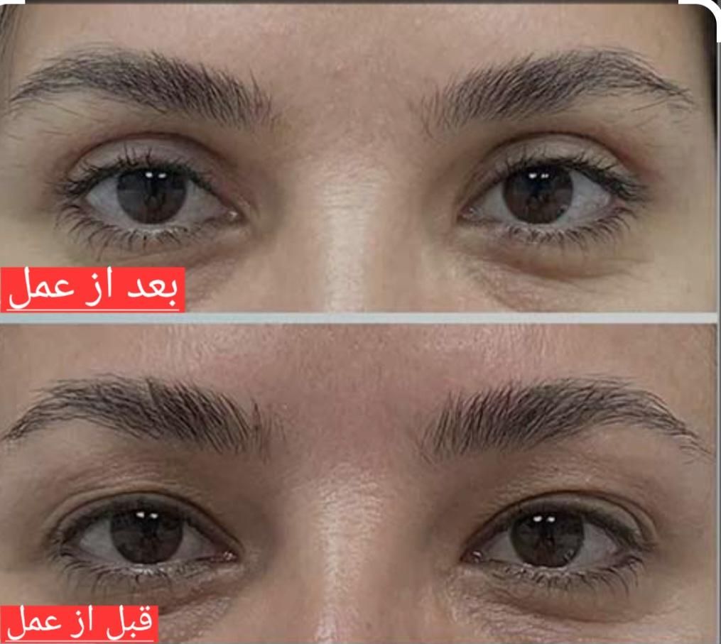 بلفارو پلاستی حرفه ای|خدمات آرایشگری و زیبایی|تهران, بلوار کشاورز|دیوار