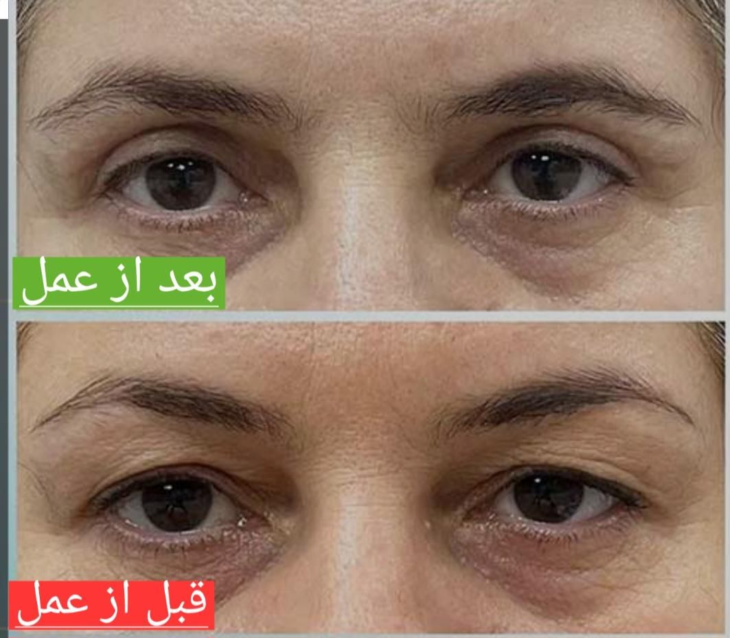 بلفارو پلاستی حرفه ای|خدمات آرایشگری و زیبایی|تهران, بلوار کشاورز|دیوار