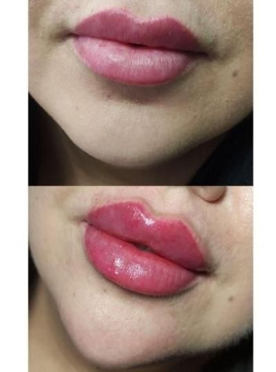 فیلر ، ژل و بوتاکس|خدمات آرایشگری و زیبایی|رباط‌کریم, |دیوار