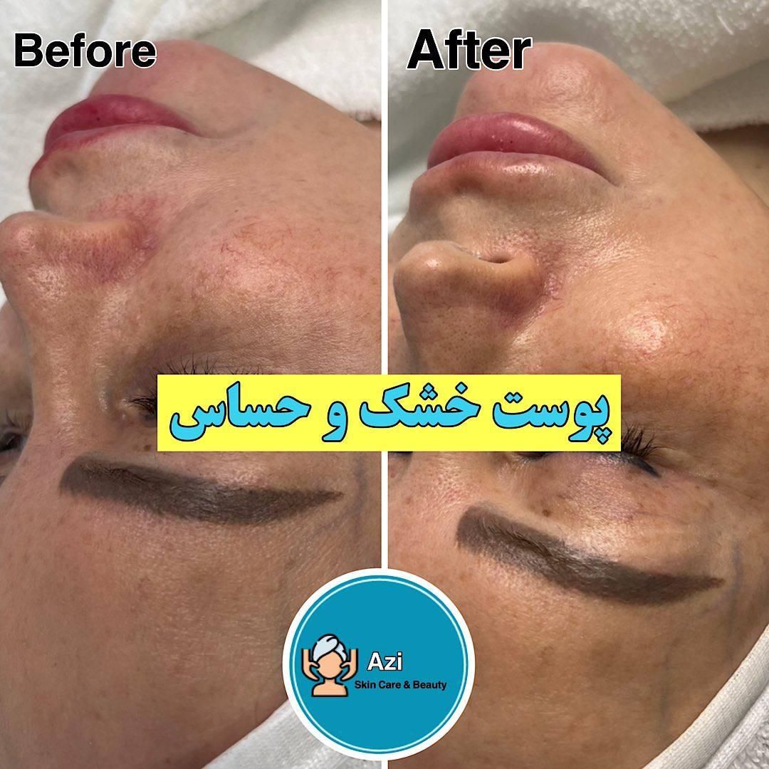 فشیال و پاکسازی پوست|خدمات آرایشگری و زیبایی|تهران, باغ فیض|دیوار