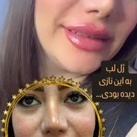 ژل لب گونه چانه لیزر رفع لک بوتاکس لاغری|خدمات آرایشگری و زیبایی|تهران, هفت حوض|دیوار