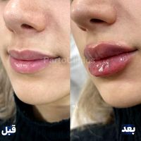 تزریق فیلر ژل توسط پزشک در کلینیک زیبایی|خدمات آرایشگری و زیبایی|تهران, تهران‌سر|دیوار