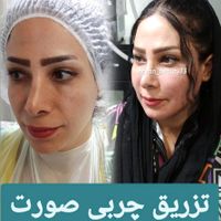 آموزش تخصصی بلفارو پلاستی و تزریق چربی|خدمات آموزشی|تهران, بلوار کشاورز|دیوار